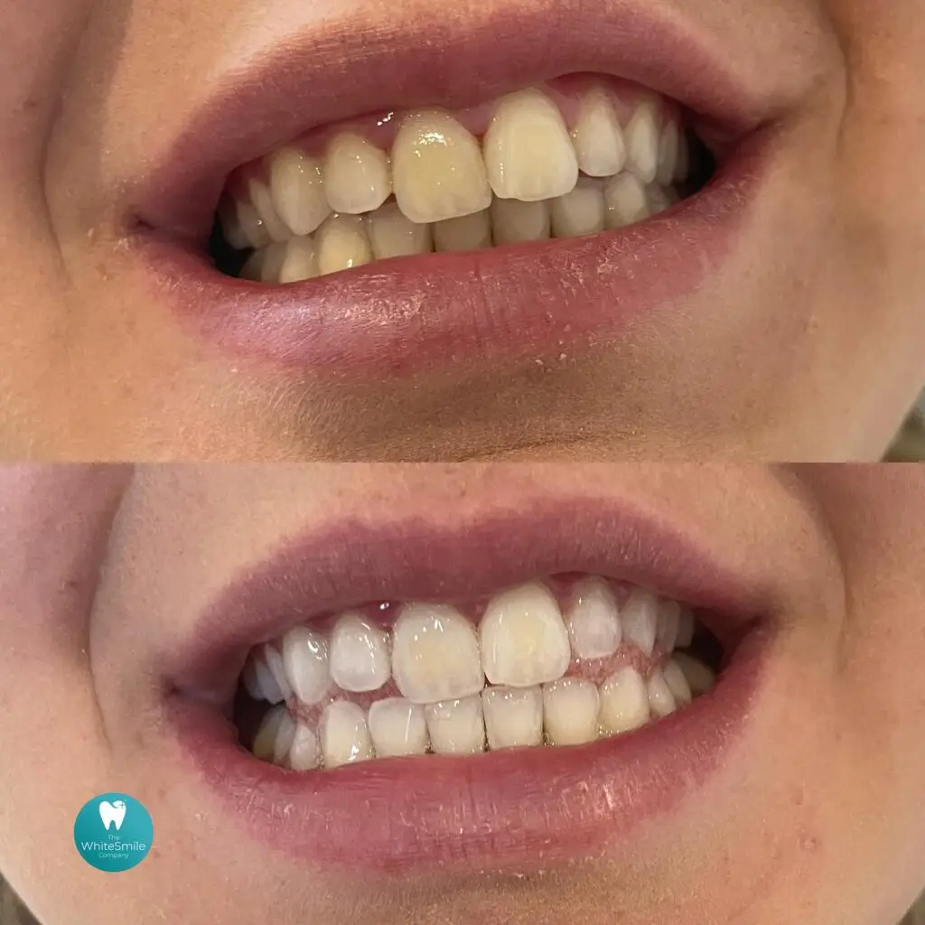 Before and after Laser Teeth whitening Christchurch