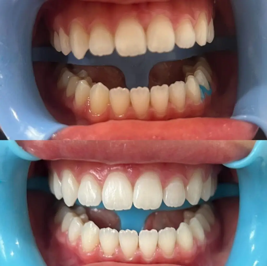 Before and after Laser Teeth whitening Christchurch