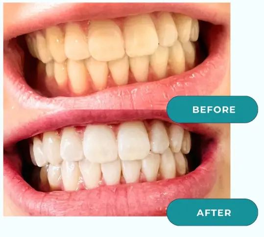 Before and after Laser Teeth whitening Christchurch